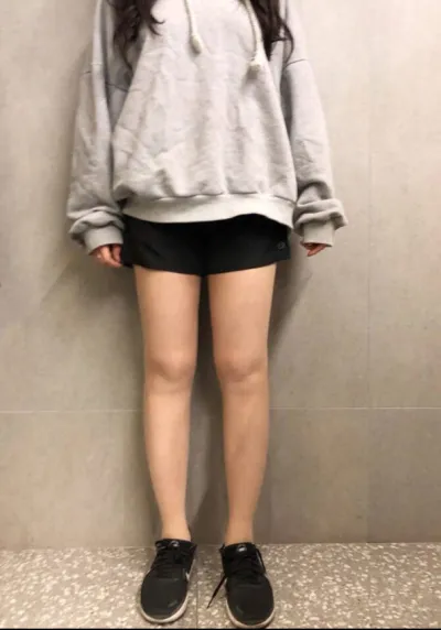 [지방흡입] 꺅긱꺅 - 지방흡입