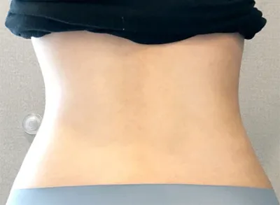 [지방흡입] 꿀타빈 - 종아리,복부지방흡입