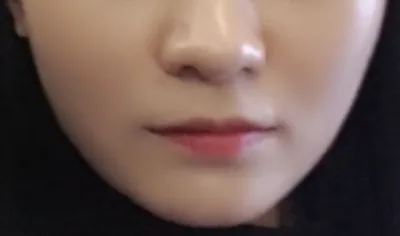 [쁘띠] 수비니ts - 입술필러