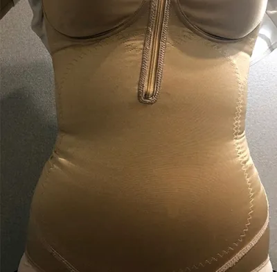 [지방흡입] 별처럼날아라 - 복부,종아리 지방흡입