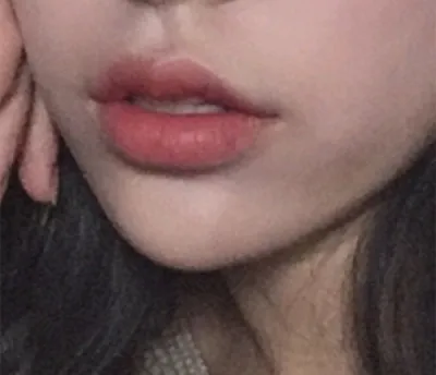 [쁘띠] 뭐라고할까나 - 입술필러, 보톡스