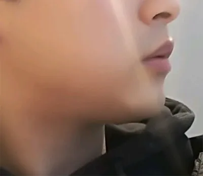 [피부] 꺄륵릌 - 슈링크,윤곽톡스