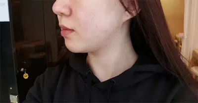 [피부] 시로마시마로 - 슈링크400샷