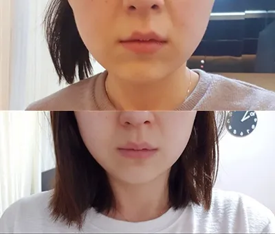 [쁘띠] deinmm - 슈링크, 윤곽톡스