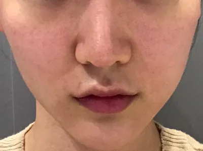 [피부] nomango - 모공