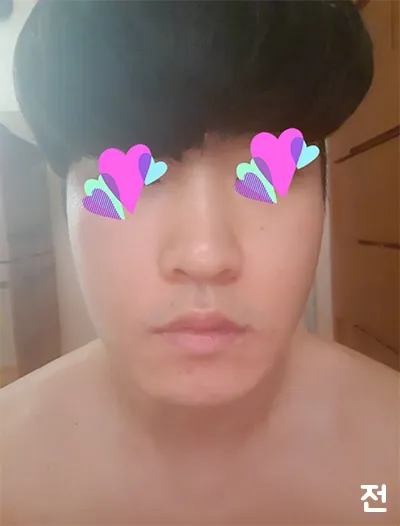 [피부] 용이지롱 - 슈링크