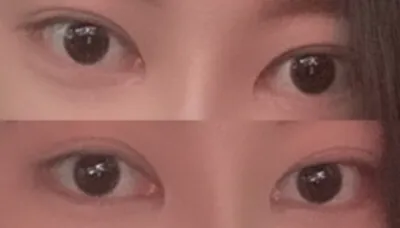 [눈] 두치쓰 - 눈재수술