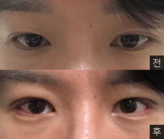 [눈] 창박이 - 눈