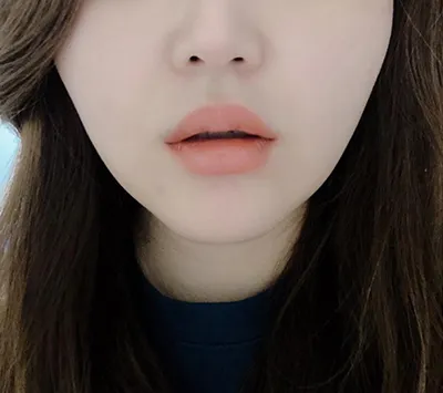 [쁘띠] 블린이이 - 입꼬리보톡스, 입술필러