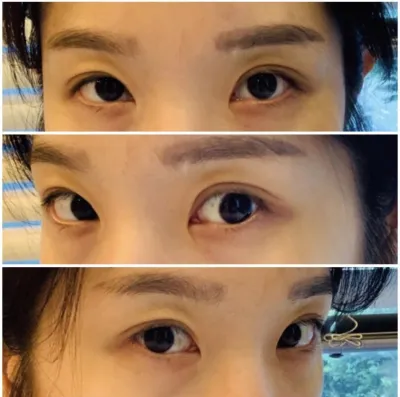 [눈] 따딴블리 - 앞트임, 윗트임