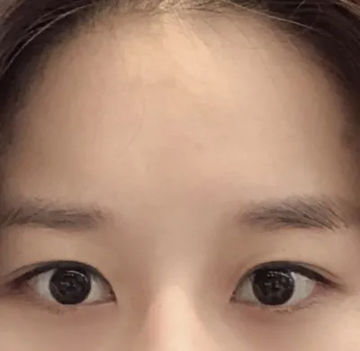 [눈] 슌귱이 - 뒤트임, 밑트임