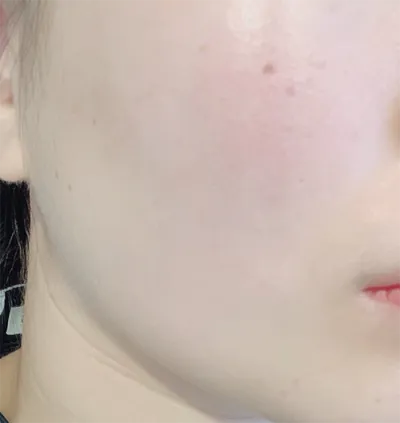 [피부] 샷키토뀨 - 슈링크