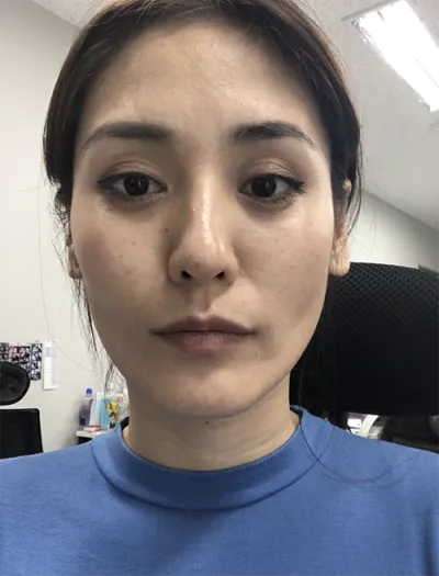 [안티에이징] 나모나 - 풀페이스 지방이식