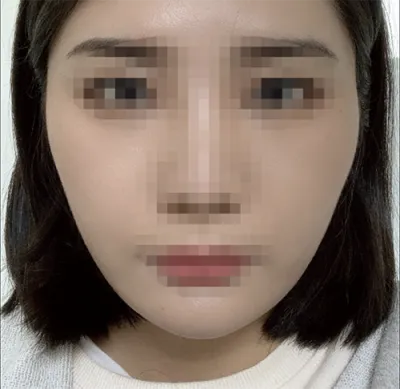 [안면윤곽] 오잉잉아 - 안면윤곽, 코, 지방이식