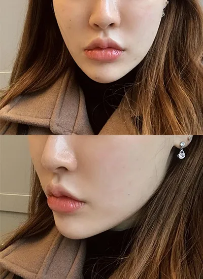 [피부] 예뻐지구싶다후 - 슈링크, 윤곽톡스