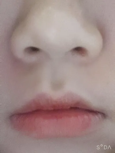 [쁘띠] ds0405 - 보톡스