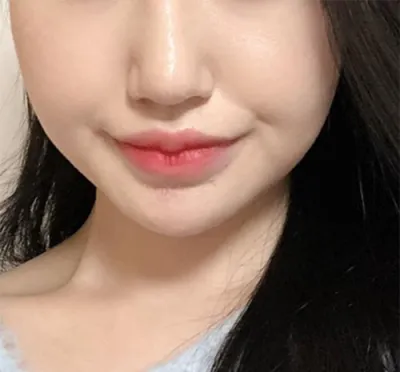 [피부] 지짖지지지지 - 슈링크,윤곽톡신