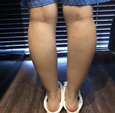 [쁘띠] 쁑귱 - 보톡스,지방분해주사