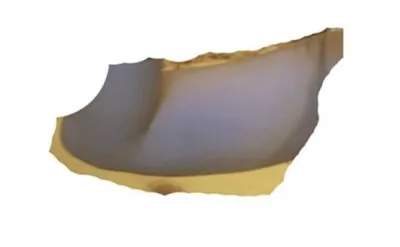 [지방흡입] 끝이없군 - 지방흡입