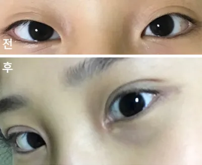 [눈] solmdd - 앞트임,눈매교정