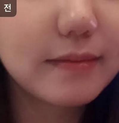 [피부] oy1004 - 리프팅,물광주사