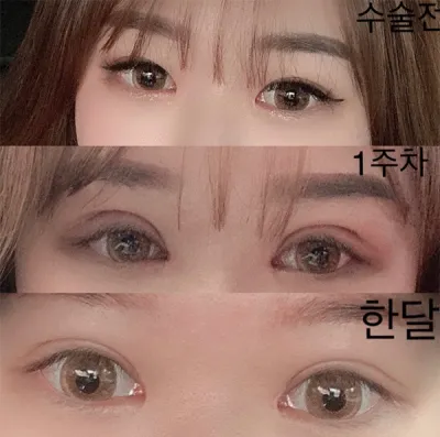 [눈] 로시온 - 윗트임, 눈매교정, 재수술