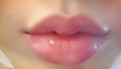 [쁘띠] 정든2 - 입술필러