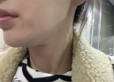 [쁘띠] 루돌프어뭉 - 보톡스, 윤곽주사