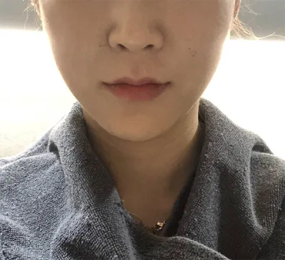 [피부] kkkkyu - 울쎄라