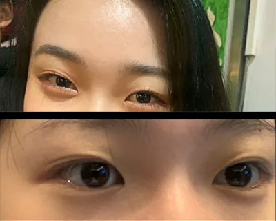 [눈] 지혜1 - 매몰,눈매교정