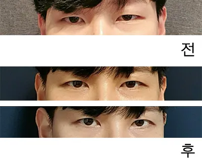 [눈] WDHH - 눈매교정