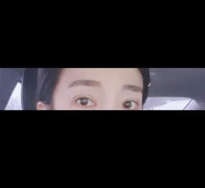 [눈] 하프바프 - 눈 재수술