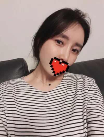 [안티에이징] ㅅㄴㄷㄴㅅㅊ - 눈,지방이식