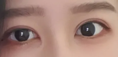 [눈] 므링 - 앞트임,눈 재수술