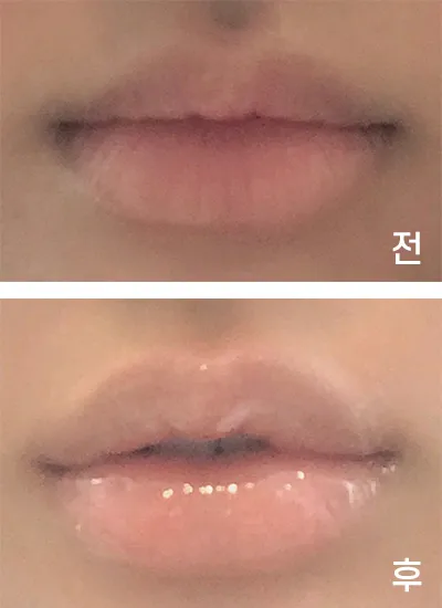 [쁘띠] ㅎ링ㅇ - 입꼬리,입술필러