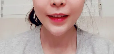 [피부] gus0311 - 필러,리프팅