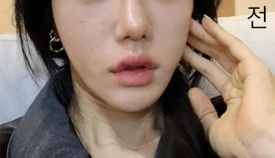 [피부] 링그리동동 - 에어젯 리프팅