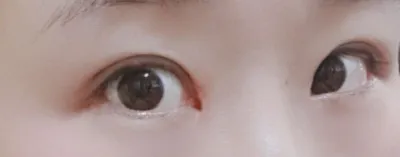 [눈] 핑구찐 - 눈매교정, 트임