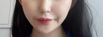 [피부] 다굥다굥 - 울쎼라, 에어젯