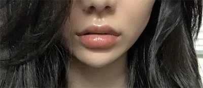 [쁘띠] 치키이인ㅇㅇ - 필러, 리프팅