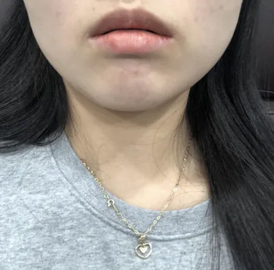 [쁘띠] soosooh - 보톡스,필러