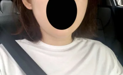 [안티에이징] 플레인817 - 얼굴지방흡입