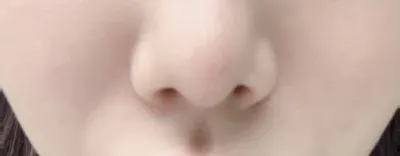 [안티에이징] 워니vv - 지방이식