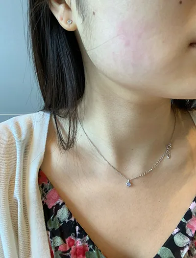 [피부] 카페오레 - 울쎄라리프팅