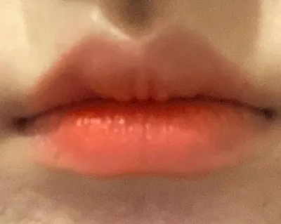 [쁘띠] 라푼절@ - 입술필러