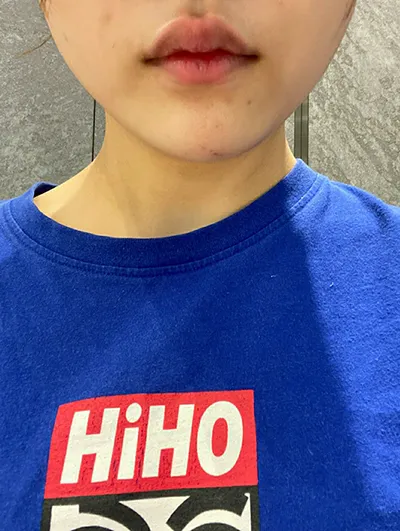 [쁘띠] 지윤스 - 사각턱보톡스