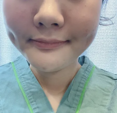 [지방흡입] kimy226 - 얼굴지방흡입