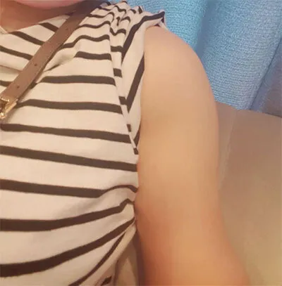 [지방흡입] 라리오레로 - 지방흡입