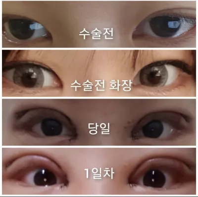 [눈] 고기영 - 쌍꺼풀,윗트임,밑트임