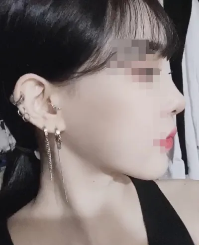 [안면윤곽] 니니❤ - 눈,안면윤곽